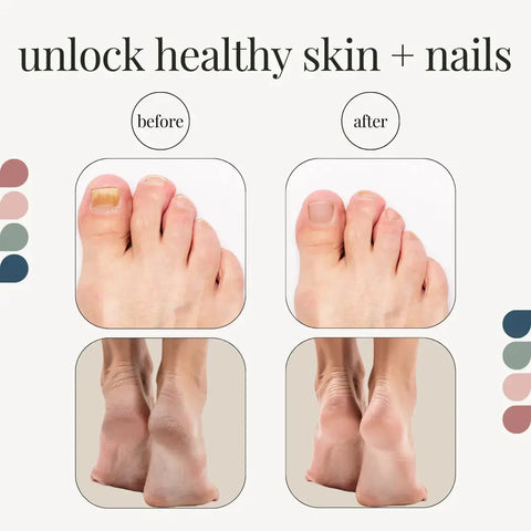 Athlete's Foot and Nail Fungus Kit Modern Podiatrist