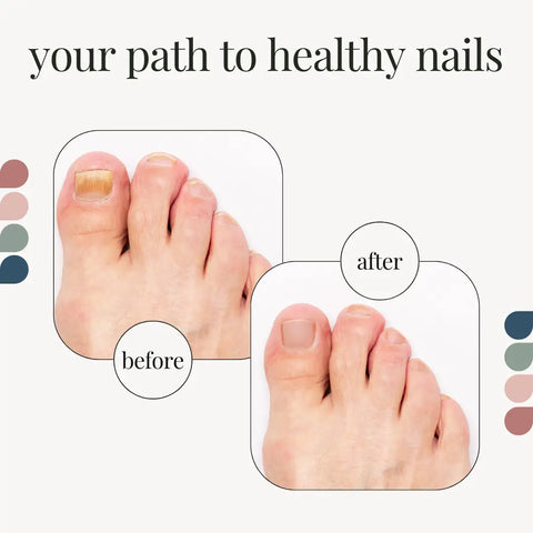 nail fungus treatment kit Modern Podiatrist